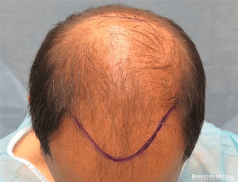 lcf hair transplant